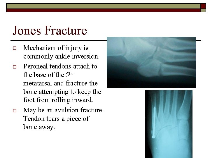 Jones Fracture o o o Mechanism of injury is commonly ankle inversion. Peroneal tendons