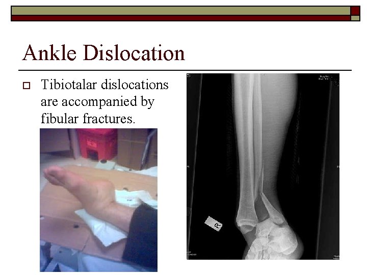 Ankle Dislocation o Tibiotalar dislocations are accompanied by fibular fractures. 