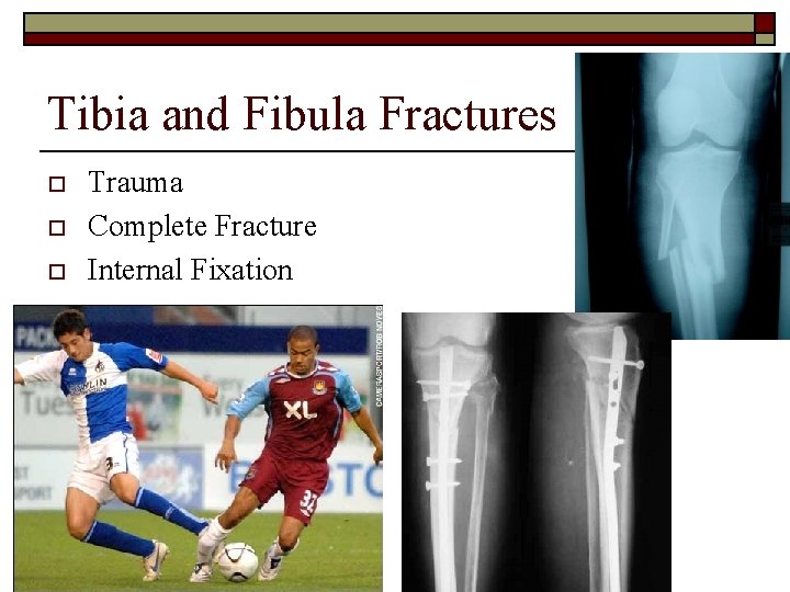 Tibia and Fibula Fractures o o o Trauma Complete Fracture Internal Fixation 