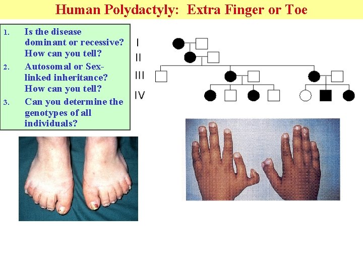 Human Polydactyly: Extra Finger or Toe 1. 2. 3. Is the disease dominant or