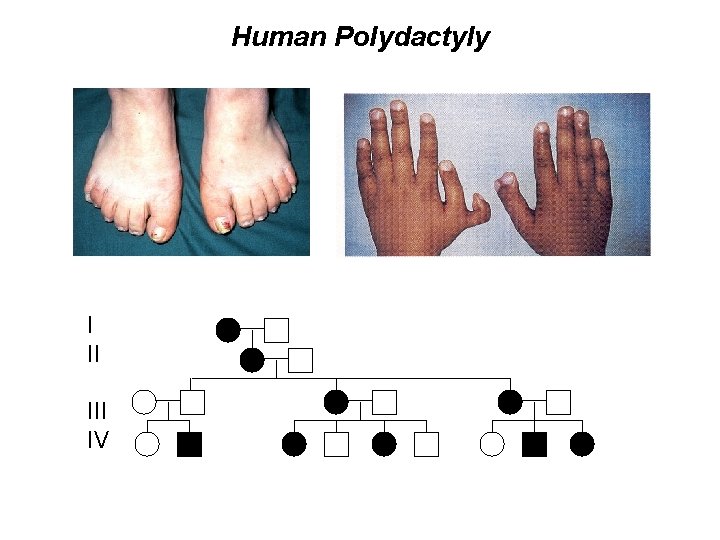 Human Polydactyly I II IV 