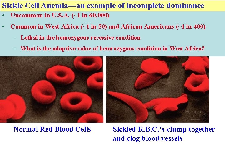 Sickle Cell Anemia—an example of incomplete dominance • Uncommon in U. S. A. (~1