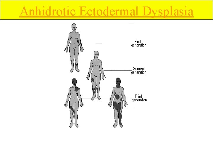 Anhidrotic Ectodermal Dysplasia 