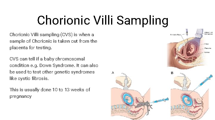 Chorionic Villi Sampling Chorionic Villi sampling (CVS) is when a sample of Chorionic is