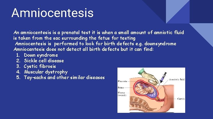 Amniocentesis An amniocentesis is a prenatal test it is when a small amount of