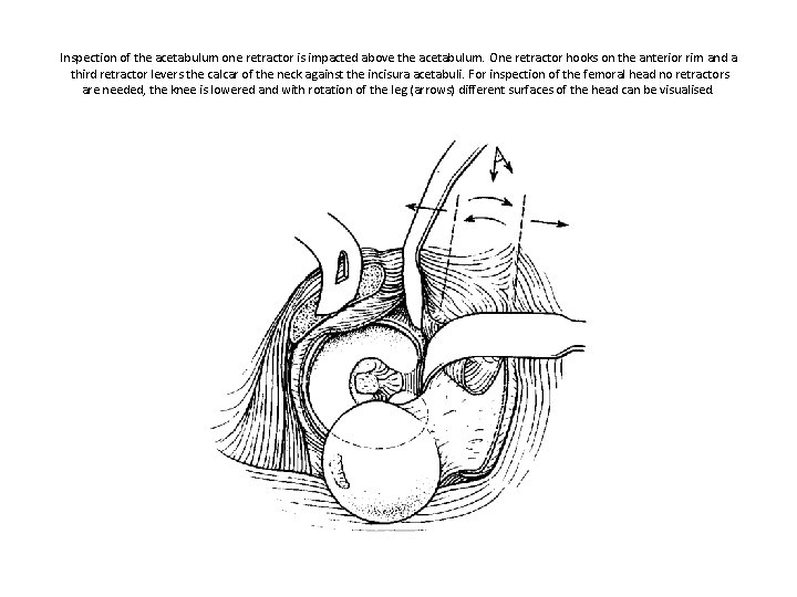 Inspection of the acetabulum one retractor is impacted above the acetabulum. One retractor hooks