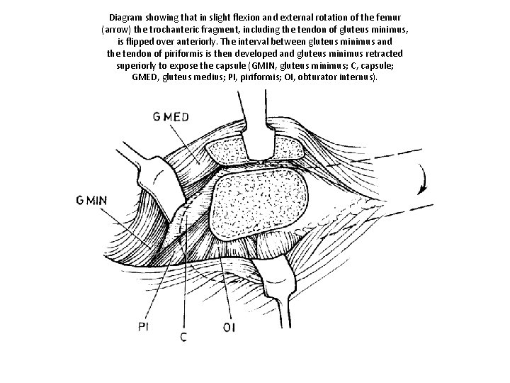 Diagram showing that in slight flexion and external rotation of the femur (arrow) the