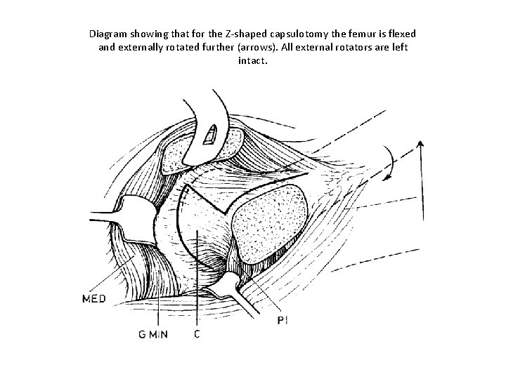Diagram showing that for the Z-shaped capsulotomy the femur is flexed and externally rotated