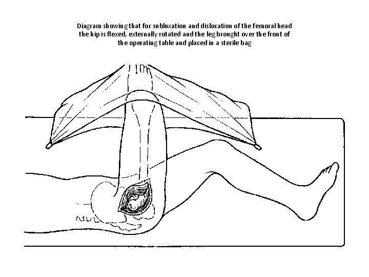 Diagram showing that for subluxation and dislocation of the femoral head the hip is