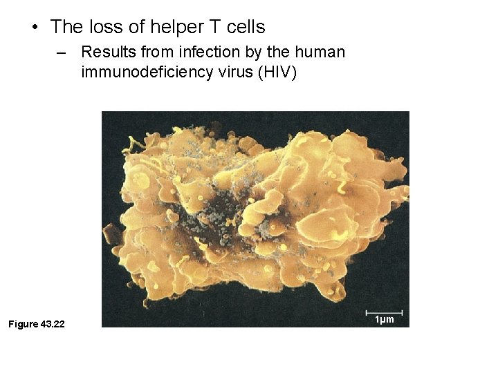  • The loss of helper T cells – Results from infection by the