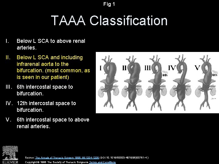 Fig 1 TAAA Classification I. Below L SCA to above renal arteries. II. Below