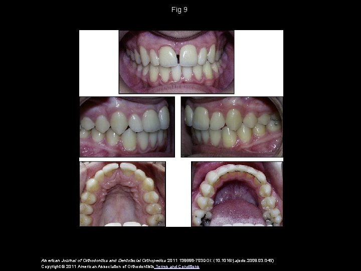 Fig 9 American Journal of Orthodontics and Dentofacial Orthopedics 2011 139698 -703 DOI: (10.