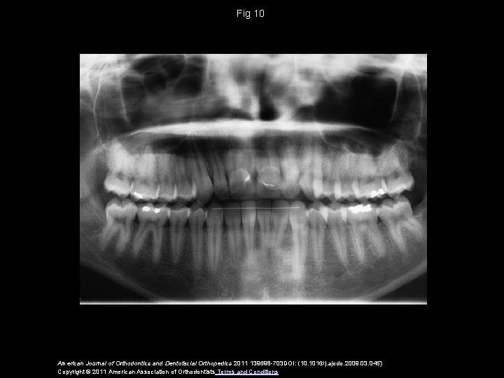Fig 10 American Journal of Orthodontics and Dentofacial Orthopedics 2011 139698 -703 DOI: (10.