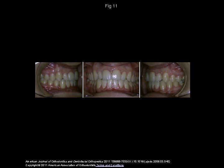 Fig 11 American Journal of Orthodontics and Dentofacial Orthopedics 2011 139698 -703 DOI: (10.