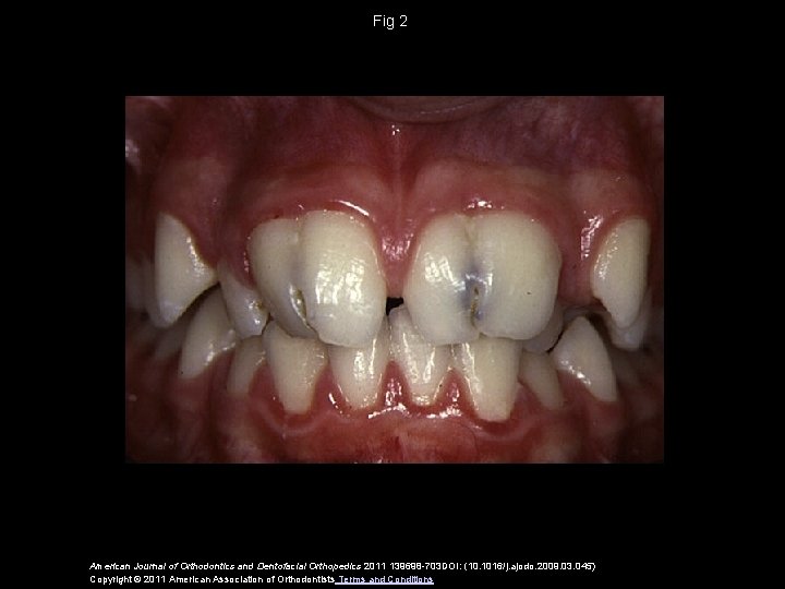 Fig 2 American Journal of Orthodontics and Dentofacial Orthopedics 2011 139698 -703 DOI: (10.