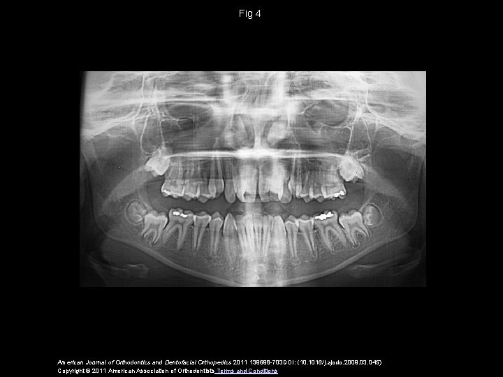 Fig 4 American Journal of Orthodontics and Dentofacial Orthopedics 2011 139698 -703 DOI: (10.