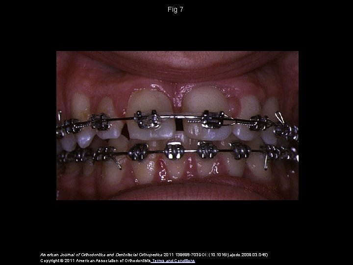 Fig 7 American Journal of Orthodontics and Dentofacial Orthopedics 2011 139698 -703 DOI: (10.
