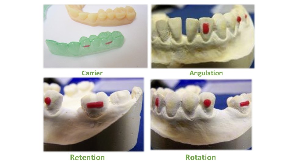 Example Attachments Carrier Retention Angulation Rotation 