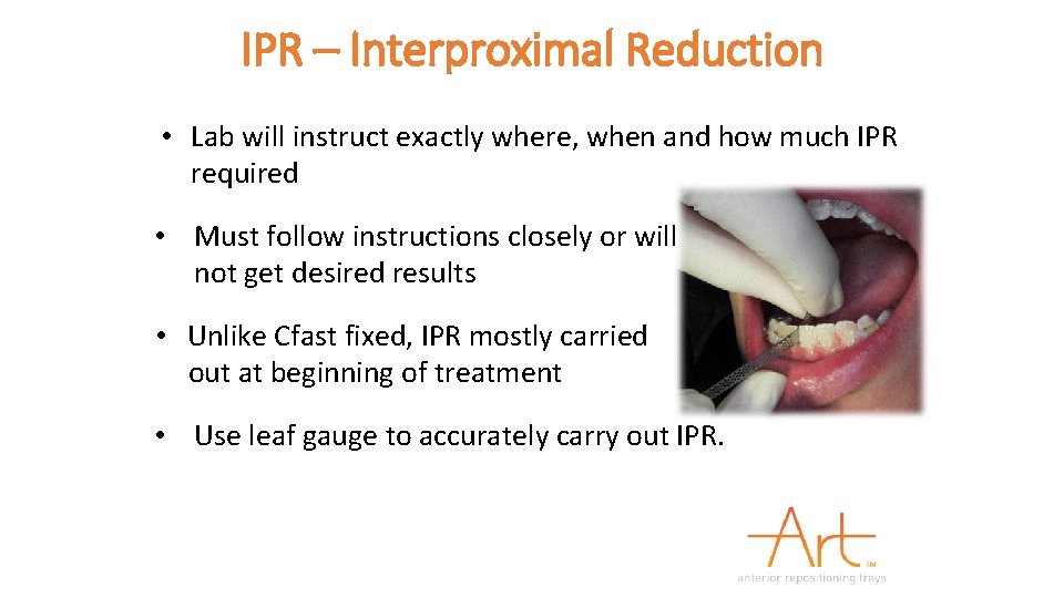 IPR – Interproximal Reduction • Lab will instruct exactly where, when and how much
