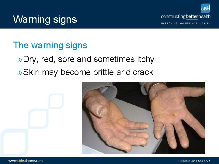 Warning signs The warning signs » Dry, red, sore and sometimes itchy » Skin