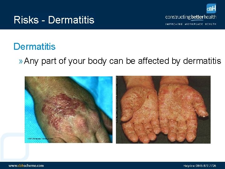 Risks - Dermatitis » Any part of your body can be affected by dermatitis