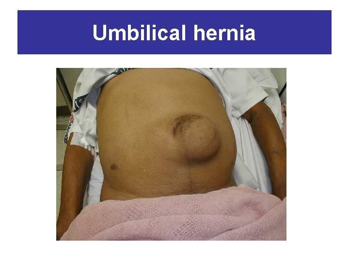 Umbilical hernia 