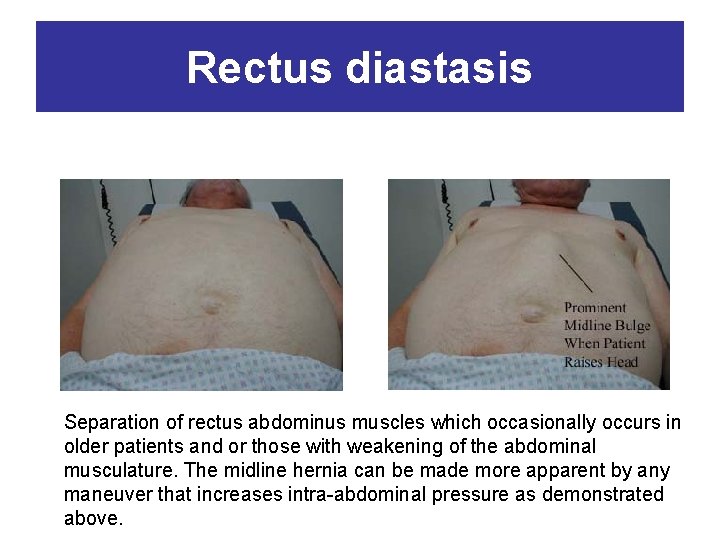 Rectus diastasis Separation of rectus abdominus muscles which occasionally occurs in older patients and