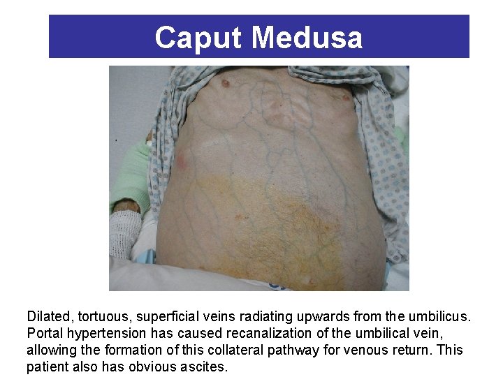 Caput Medusa Dilated, tortuous, superficial veins radiating upwards from the umbilicus. Portal hypertension has
