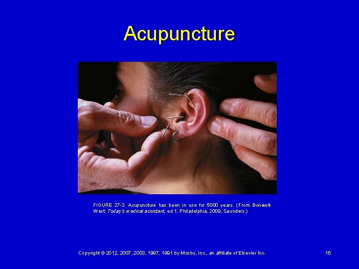 Acupuncture FIGURE 27 -3  Acupuncture has been in use for 5000 years. (From Bonewit.