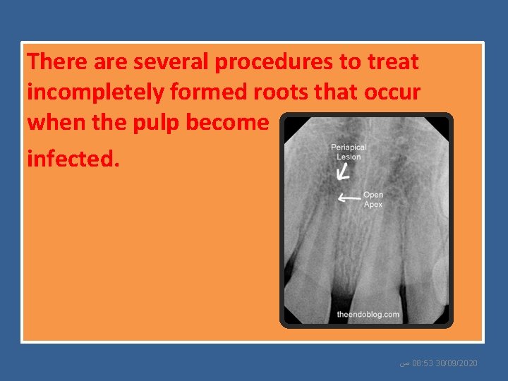 There are several procedures to treat incompletely formed roots that occur when the pulp