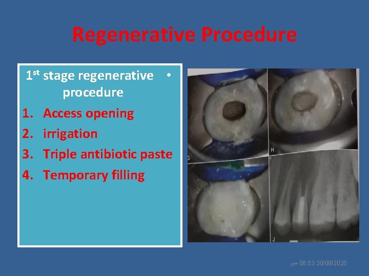 Regenerative Procedure 1 st stage regenerative • procedure 1. Access opening 2. irrigation 3.