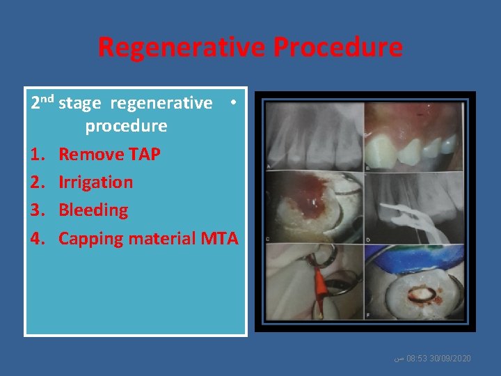 Regenerative Procedure 2 nd stage regenerative • procedure 1. Remove TAP 2. Irrigation 3.