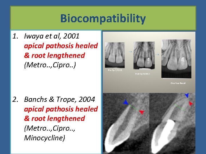 Biocompatibility 1. Iwaya et al, 2001 apical pathosis healed & root lengthened (Metro. .