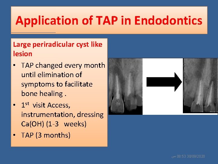 Application of TAP in Endodontics Large periradicular cyst like lesion • TAP changed every