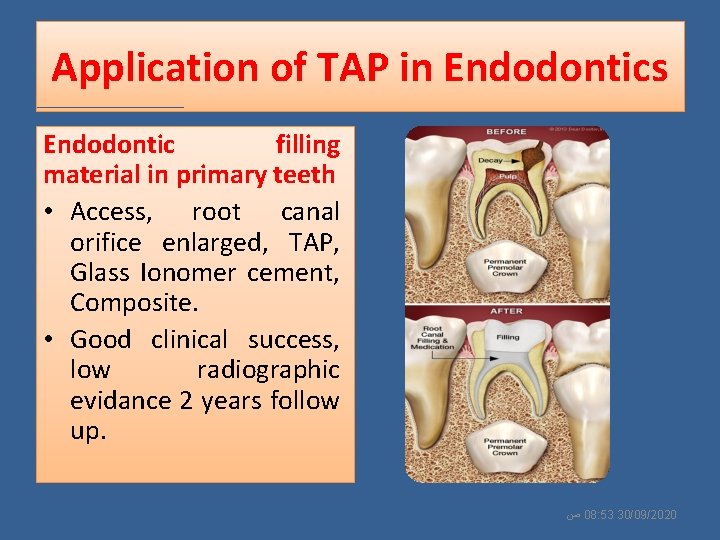 Application of TAP in Endodontics Endodontic filling material in primary teeth • Access, root
