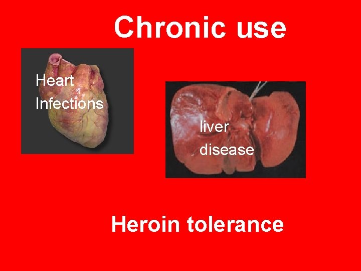 Chronic use Heart Infections liver disease Heroin tolerance 