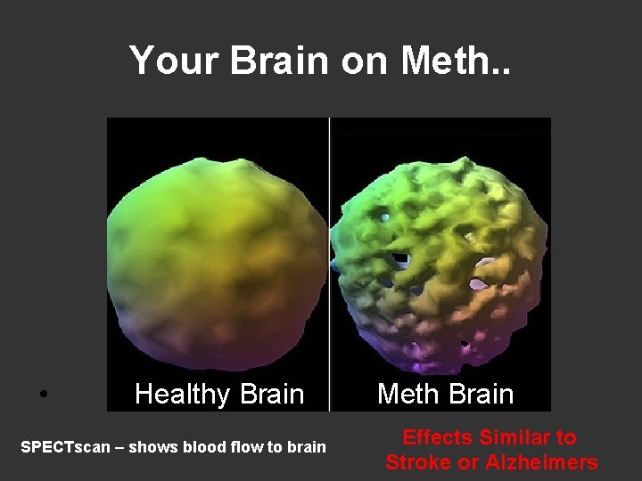 Your Brain on Meth. . • Healthy Brain SPECTscan – shows blood flow to