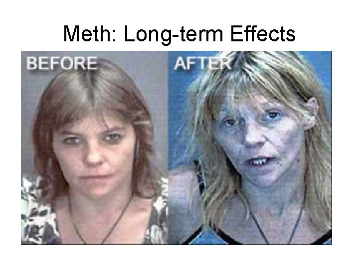 Meth: Long-term Effects 