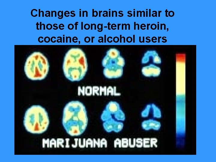 Changes in brains similar to those of long-term heroin, cocaine, or alcohol users 