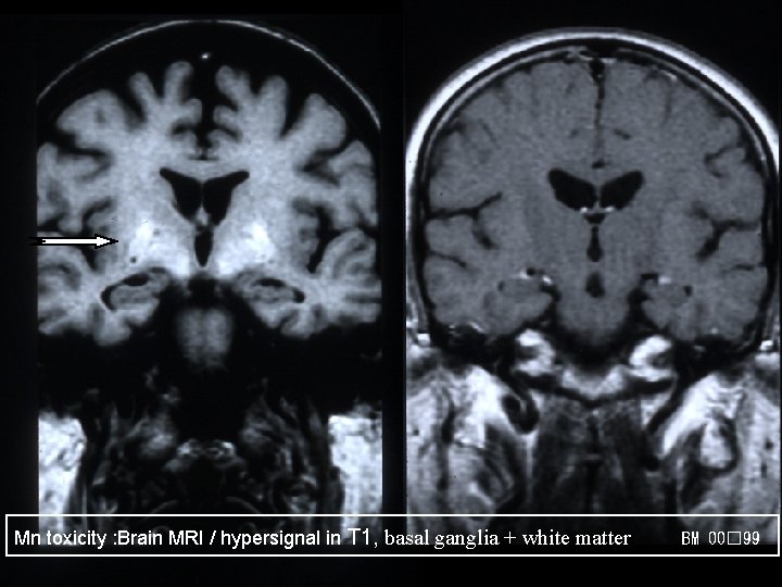 Mn toxicity : Brain MRI / hypersignal in T 1, basal ganglia + white