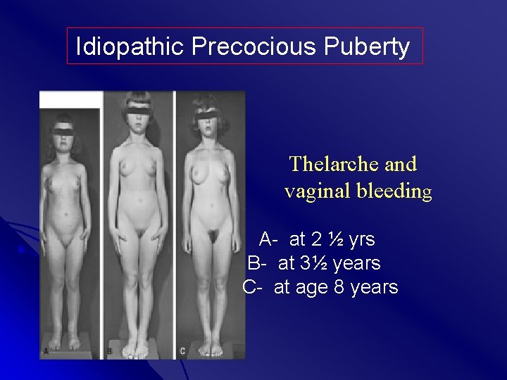 Idiopathic Precocious Puberty Thelarche and vaginal bleeding A- at 2 ½ yrs B- at