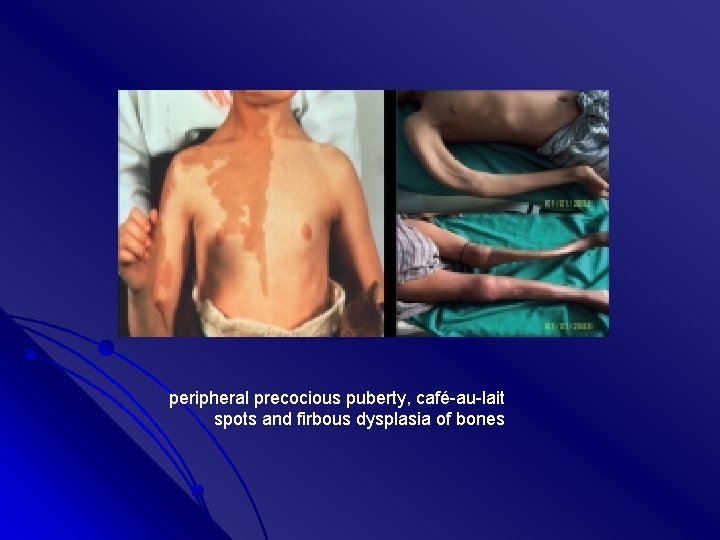 peripheral precocious puberty, café-au-lait spots and firbous dysplasia of bones 