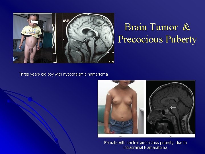 Brain Tumor & Precocious Puberty Three years old boy with hypothalamic hamartoma Female with