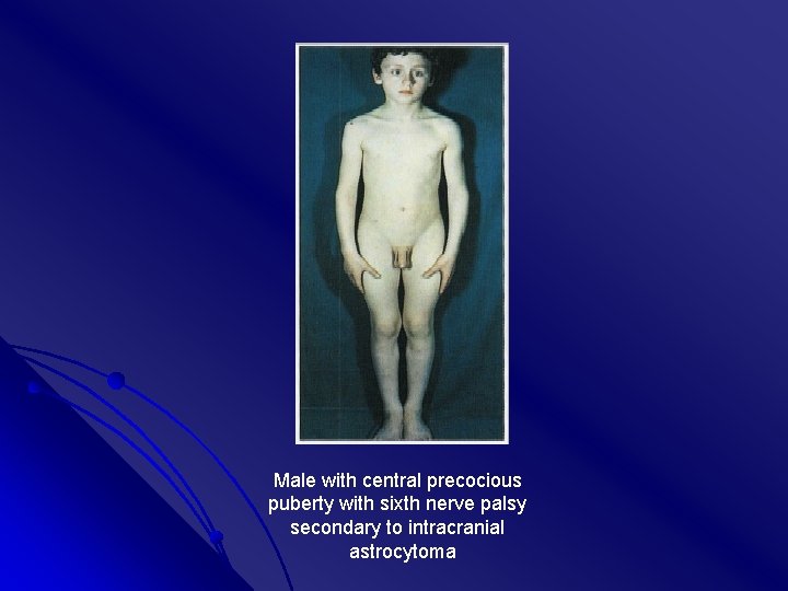 Male with central precocious puberty with sixth nerve palsy secondary to intracranial astrocytoma 