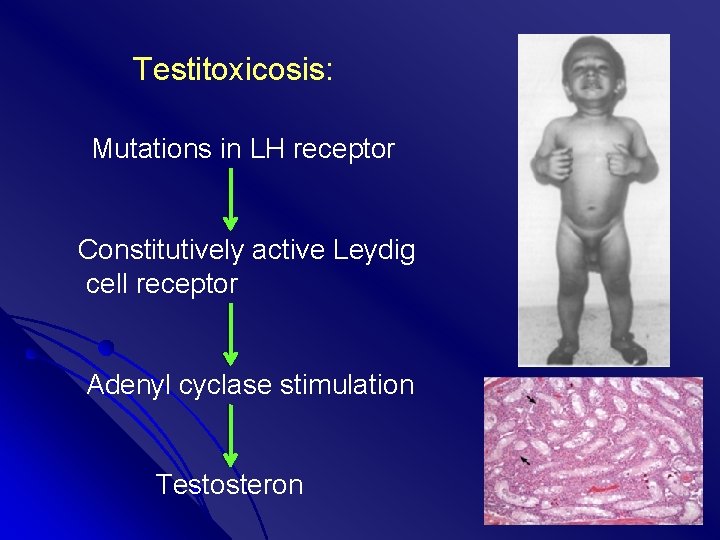  Testitoxicosis: Mutations in LH receptor Constitutively active Leydig cell receptor Adenyl cyclase stimulation