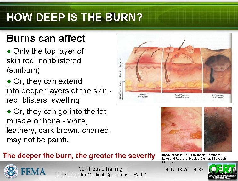 HOW DEEP IS THE BURN? Burns can affect ● Only the top layer of