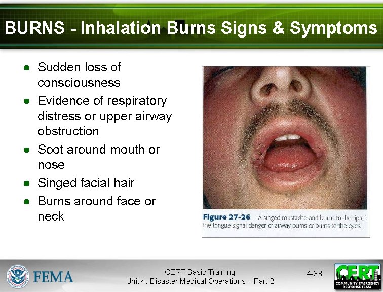 BURNS - Inhalation Burns Signs & Symptoms ● Sudden loss of consciousness ● Evidence