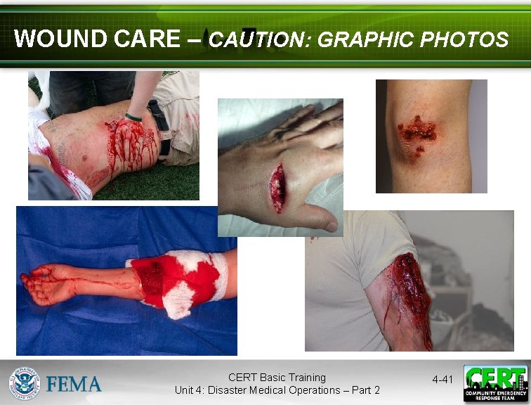 WOUND CARE – CAUTION: GRAPHIC PHOTOS CERT Basic Training Unit 4: Disaster Medical Operations