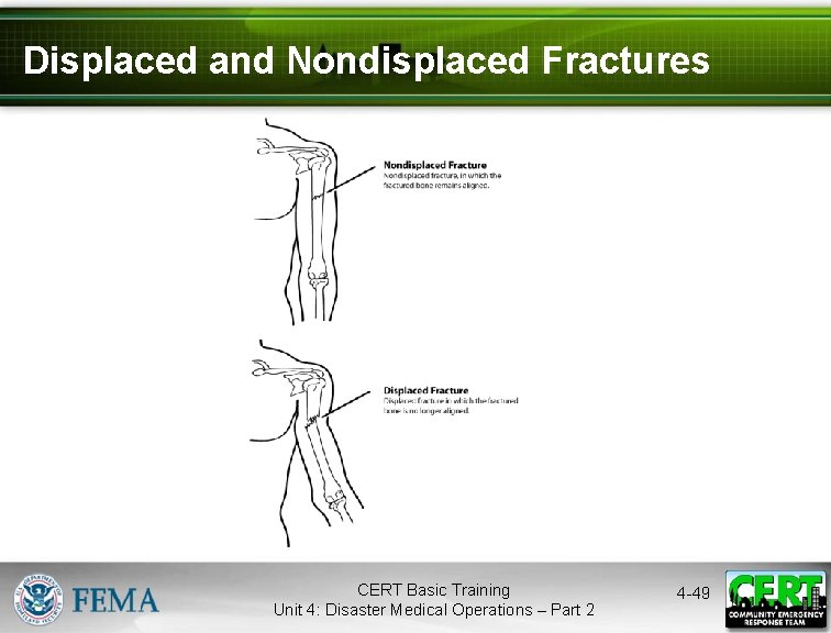 Displaced and Nondisplaced Fractures CERT Basic Training Unit 4: Disaster Medical Operations – Part