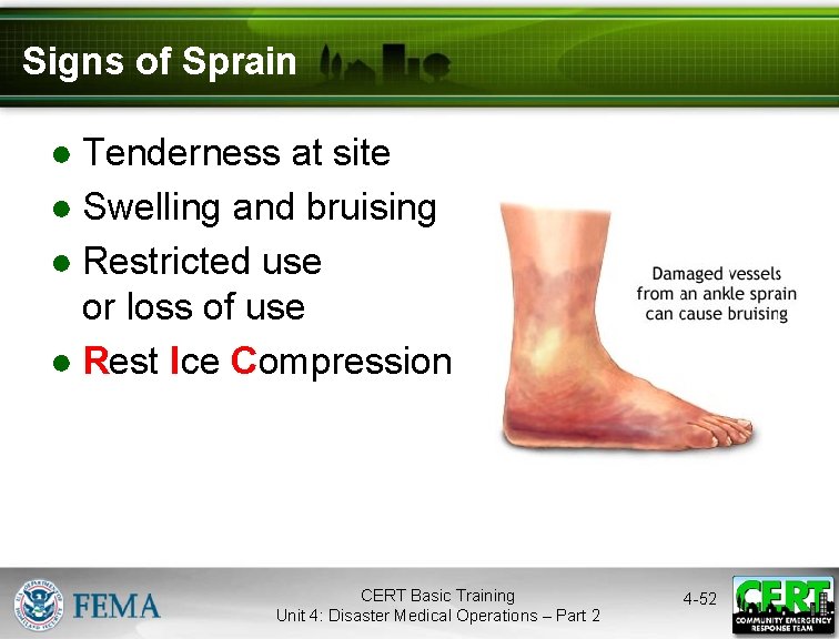 Signs of Sprain ● Tenderness at site ● Swelling and bruising ● Restricted use